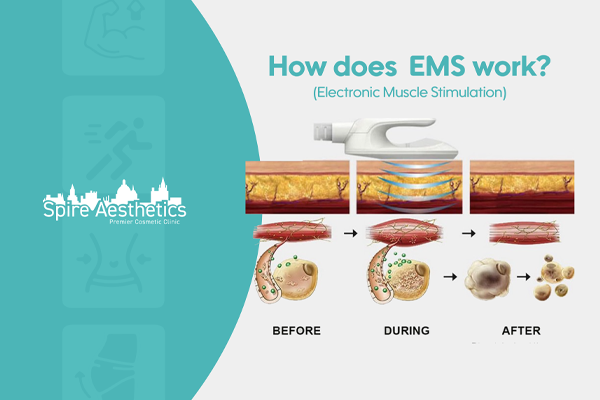 EMS treatment for post pregnancy weight loss treatment Brighton