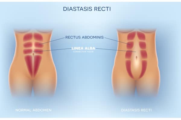 What Non-Surgical Options Are Available for Diastasis Recti Brighton?
