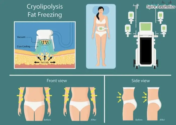 Fat freezing treatment Brighton benefits for competitions to remove stubborn fat deposits.