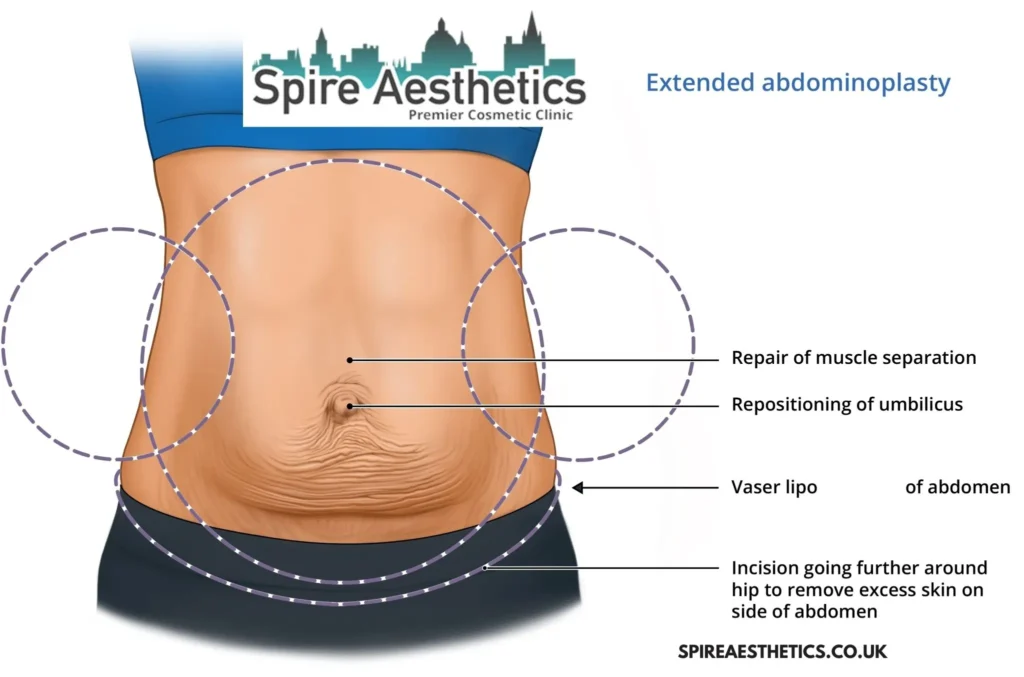 Understanding Loose Skin After Gastric Band Brighton Surgery and HIFU Treatment