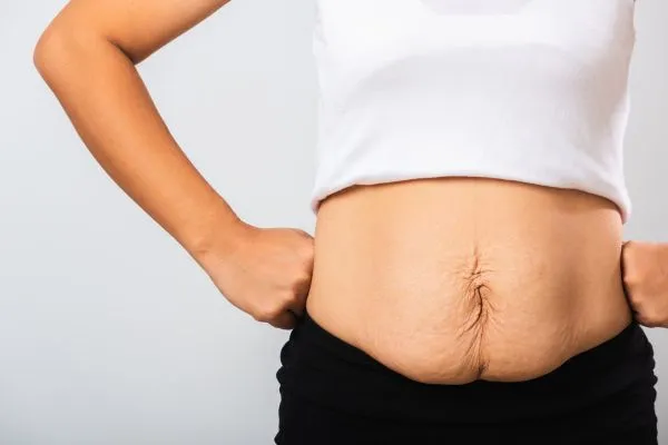 Image of a woman's stomach after weight loss with sagging skin following a gastric band Brighton
