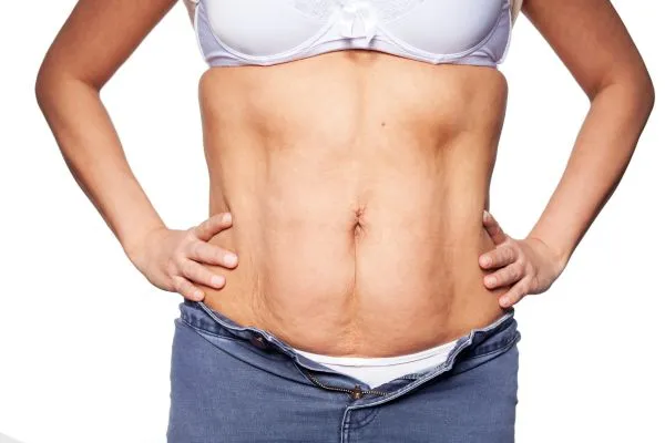 sagging skin on woman's stomach after weight loss injections Brighton
