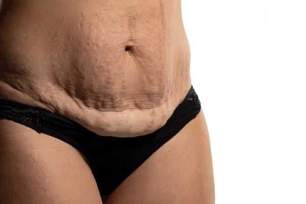 Image of womans stomach after weight loss injections Brighton showing saggy skin