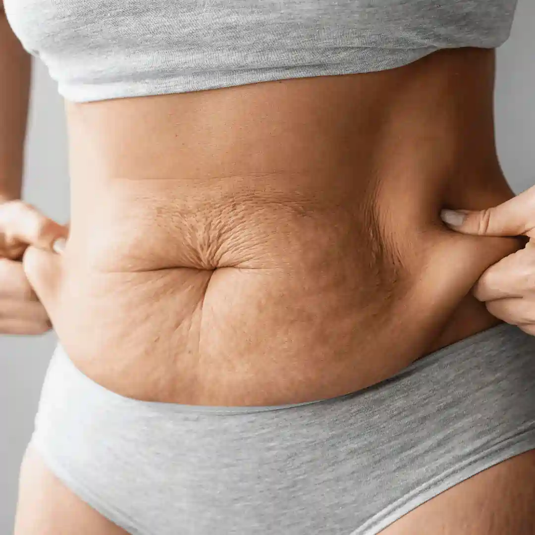 Is It Normal to Have Loose Skin After Pregnancy Brighton?
